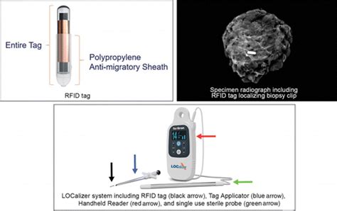 rfid tag issue|rfid tagging in breast surgery.